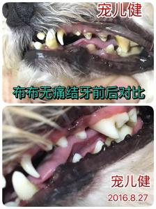 洁牙手术